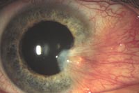 Pterygium