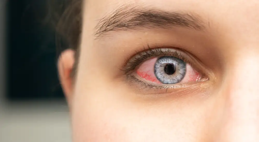 Pink Eye (Conjunctivitis) Treatment