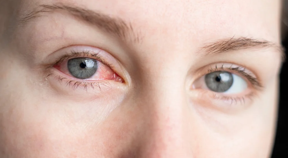 Red Eye Evaluation and Treatment