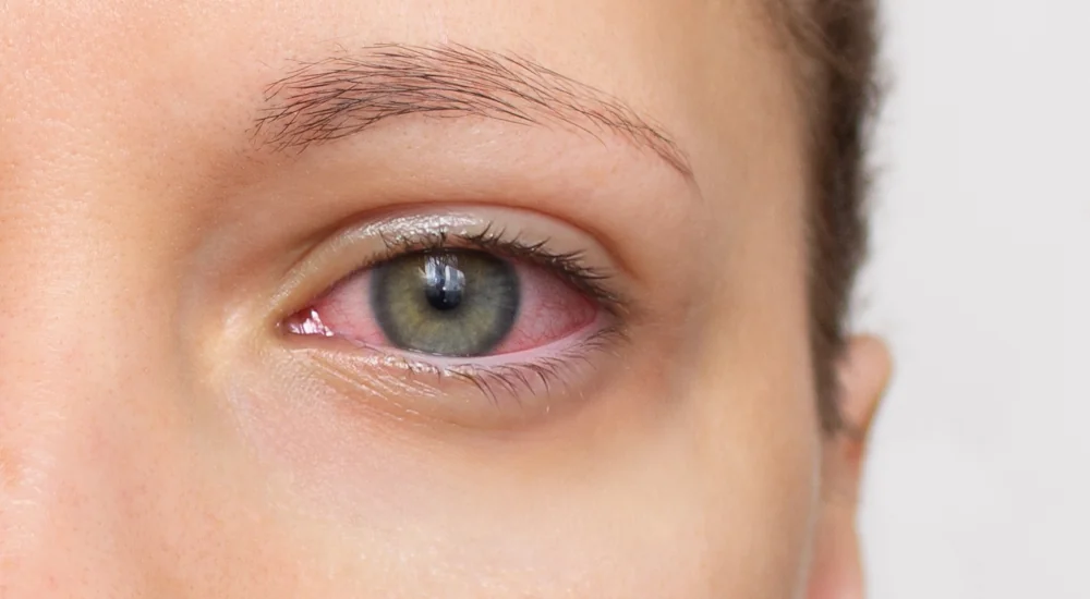 Uveitis Diagnosis and Treatment